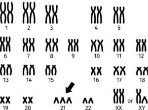 Down Syndrome Related Alzheimer S Disease