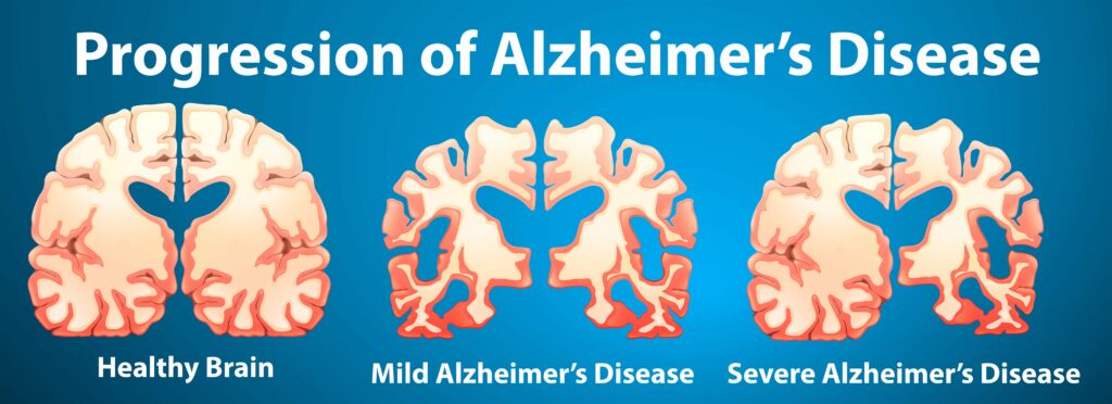 What does a brain look like with Alzheimer's disease