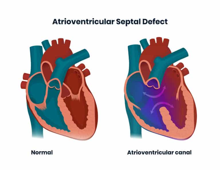 Down syndrome heart defects: Endocardial Cushion Defect / Atrioventricular Septal Defect