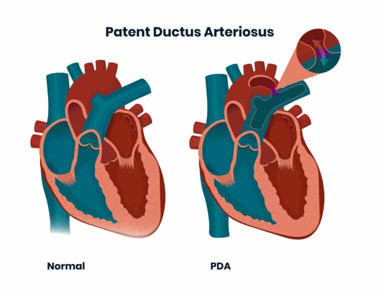 Down syndrome heart defects: Patent Ductus Arteriosus