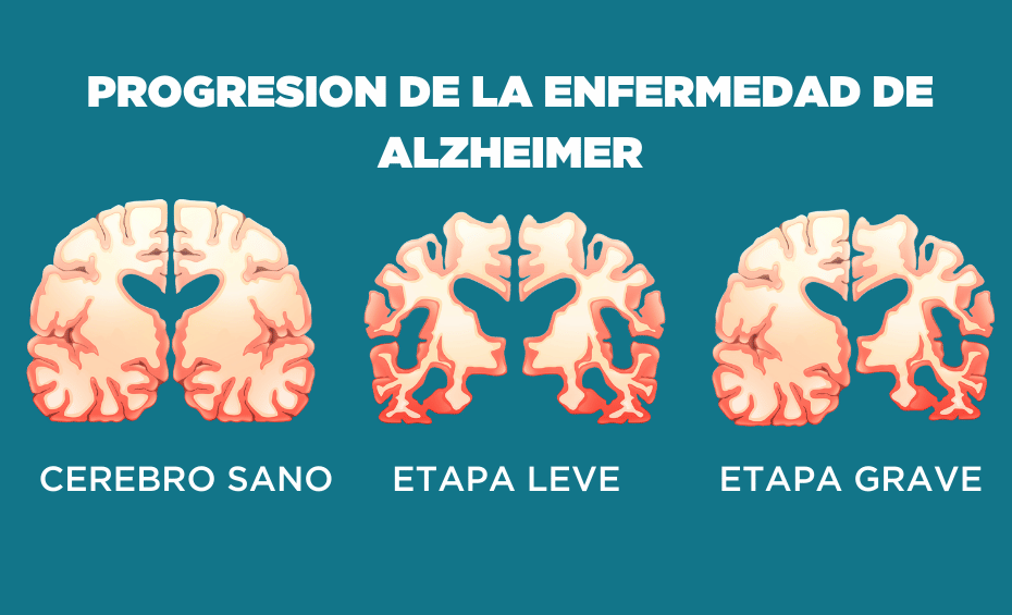 Enfermedad de Alzheimer y su conexion con el sindrome de Down Etapas de Alzheimer en el cerebro