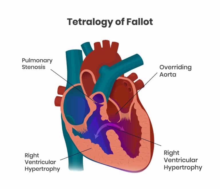 Down syndrome heart defects: Tetralogy of Fallot