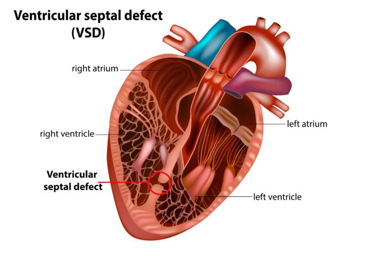 Down syndrome heart defects: Ventricular Septal Defect