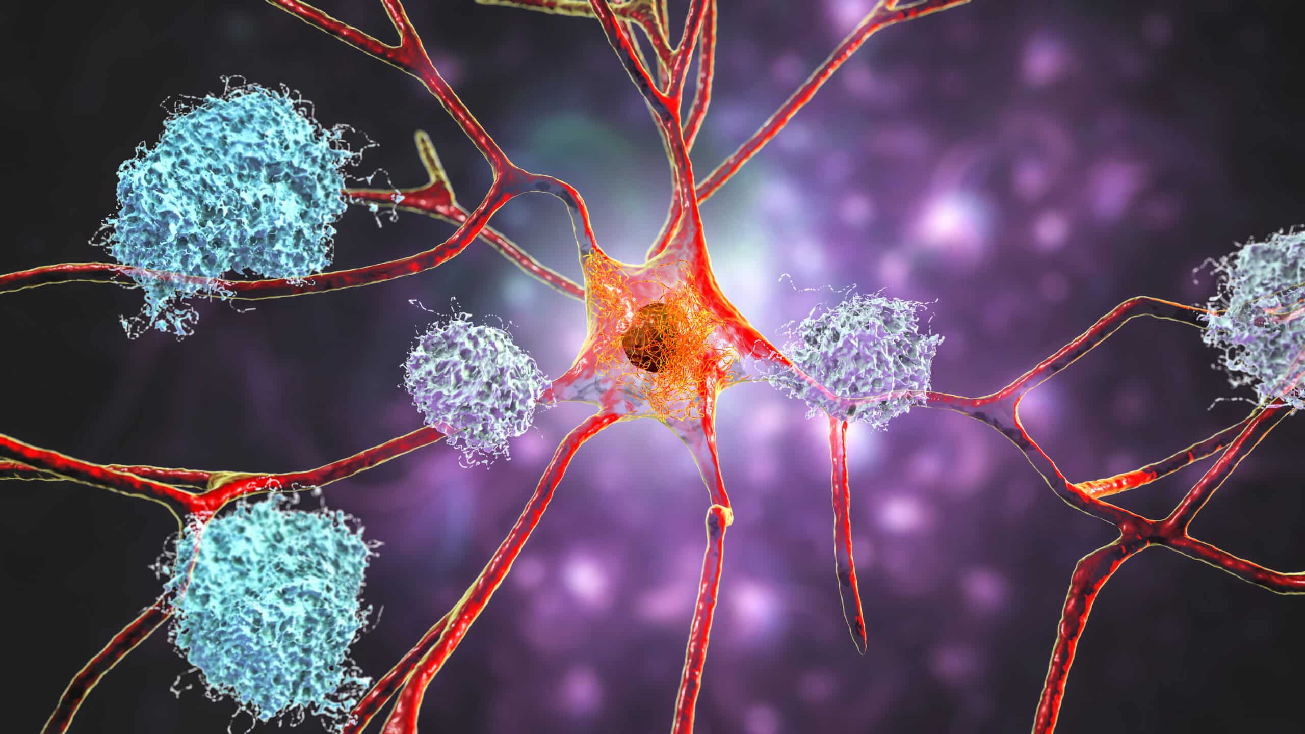 Lecanemab: New Treatment for Alzheimer’s Disease